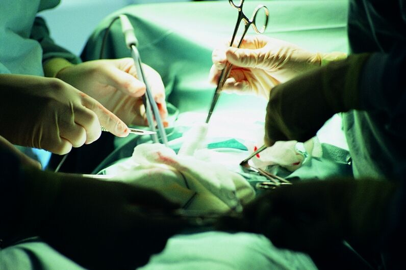 chirurgesch Erhéijung vun der Penisdicke